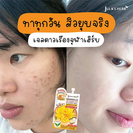 Jula's Herb เจลลดสิวดอกดาวเรือง Marigold Intensive Clear Gel 8 มล. สูตรใหม่ (แพ็ก 6 ชิ้น)