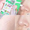 Clear nose  เจลเเต้มสิว Acne Gel Concentrate Solution 15 กรัม