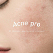 The Skin Collection เซรั่มดูแลผิวหน้า Acne Pro Serum 30 มล.